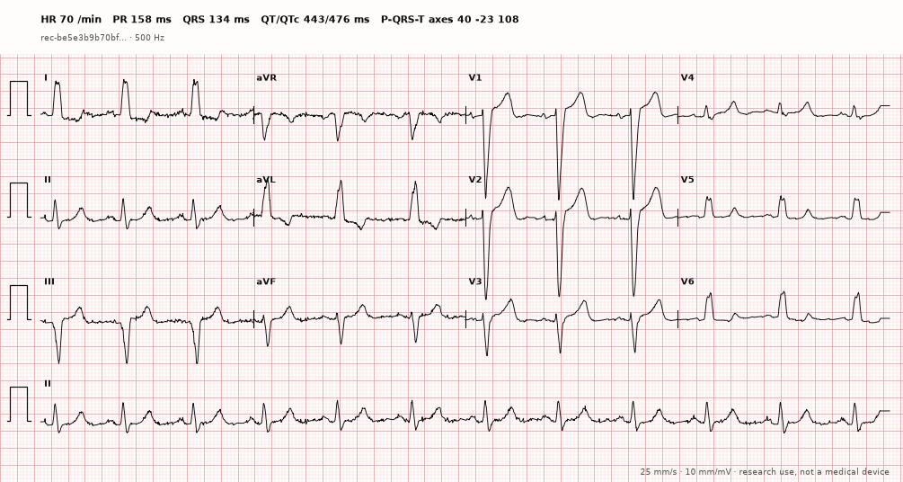12-lead ECG paper view of the bundled LBBB example