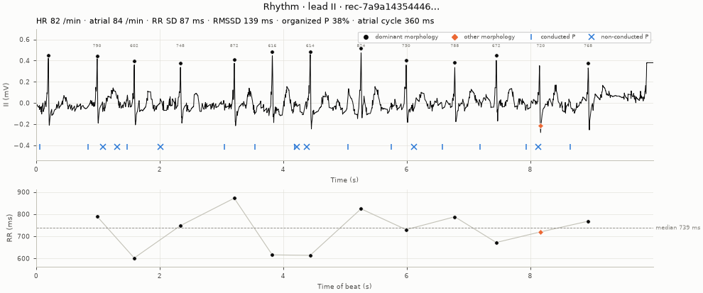 Rhythm strip and RR tachogram, atrial fibrillation